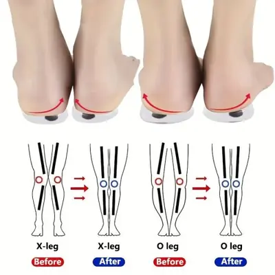 Image de Semelles Orthopédiques Anti-Valgus - Correction du Pied Plat & Douleur