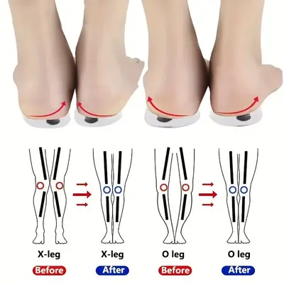 Image de Semelles Orthopédiques Anti-Valgus en Gel de Silicone